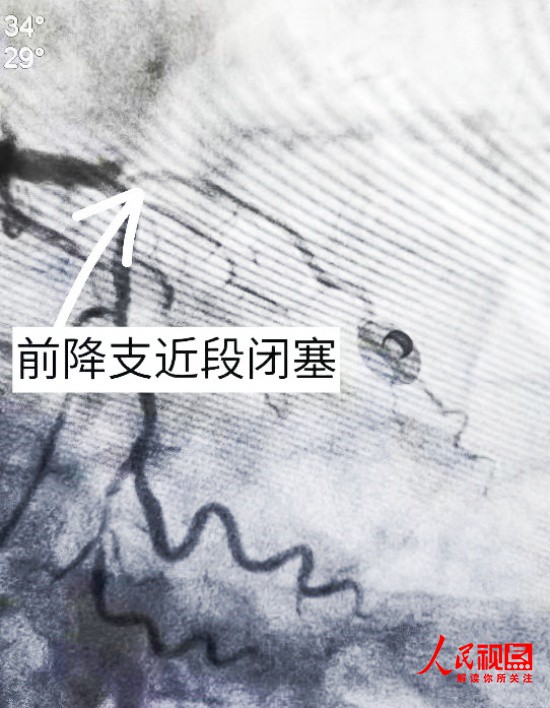 首例！大冶市中医医院医共体刘仁八分院 成功实施急性心梗溶栓治疗